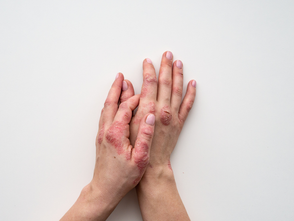 Psoriasi