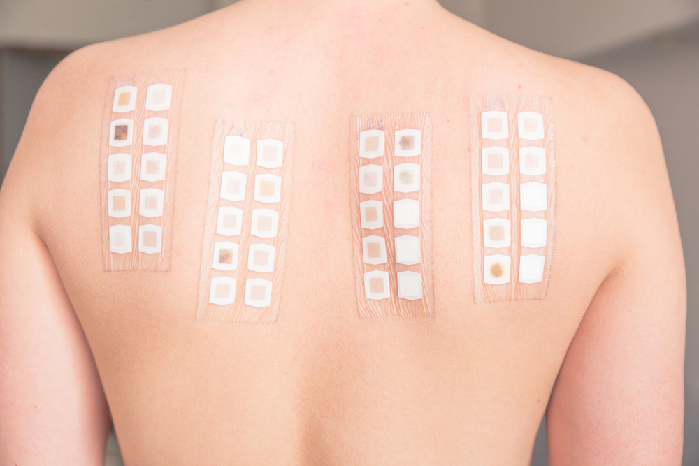 Allergeni patch test